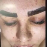 فیشال تخصصی و درمان جوش ولک Zhikan