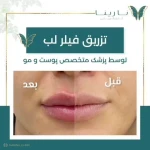 کلینیک تزریق بوتاکس و فیلر نارینا