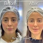 فیلر و بوتاکس  بیوتی