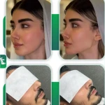فیلر و بوتاکس  بیوتی
