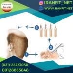 کاشت مو ایران فیت