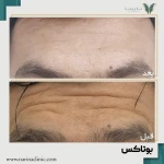 کلینیک تزریق بوتاکس و فیلر نارینا