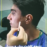 نمونه کار کلینیک تخصصی کاشت مو و ابرو رویش سبز