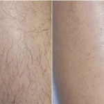 نمونه کار کلینیک پوست،مو و لیزر موهای زائد نیوانتا
