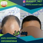 کاشت مو ایران فیت