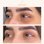 کلینیک تزریق فیلر و بوتاکس زرفیس