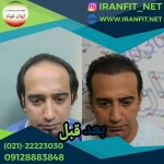 کاشت مو ایران فیت