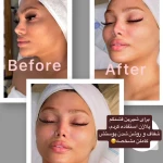  فشیال و پاکسازی پوست اوپال