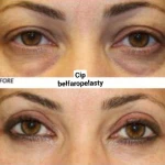 مرکز کاشت مو و ابرو فیشال cip