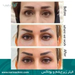 کلینیک تزریق بوتاکس و فیلر نارینا