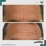 کلینیک تزریق بوتاکس و فیلر نارینا