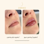کلینیک تزریق فیلر و بوتاکس زرفیس