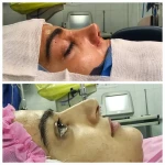 نمونه کار جراحی  زیبایی بینی  و صورت نئوفیس